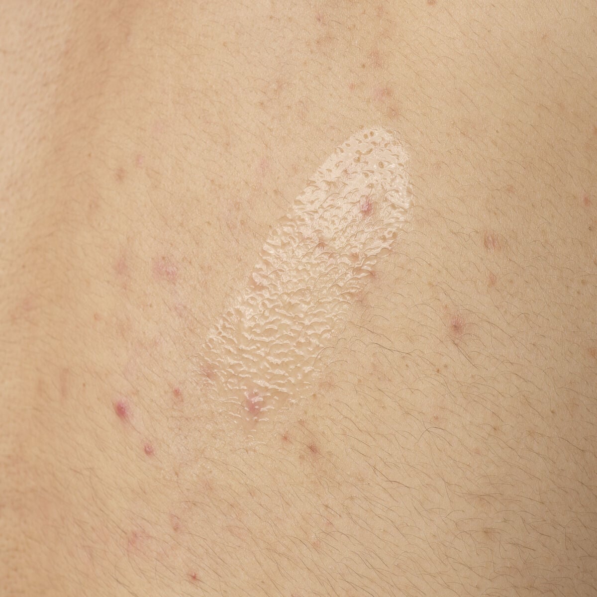 salicylic-acid-0-5-body-serum-c2 ORD-salicylic-acid-05-body-240ml-application.jpg