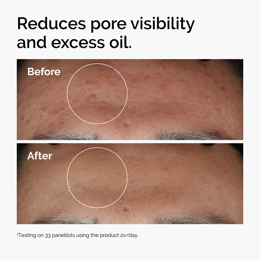 niacinamide-10-zinc-1-y5 ord-niacinamide-zinc-blemish-serum-before-after-pores.jpg