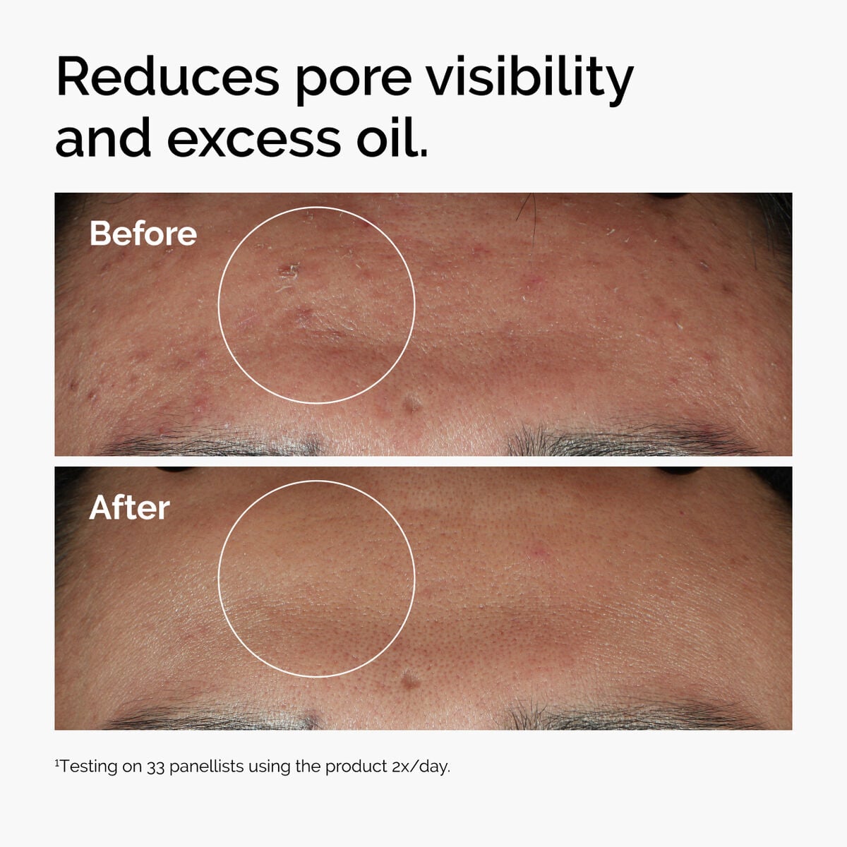 niacinamide-10-zinc-1-y5 ord-niacinamide-zinc-blemish-serum-before-after-pores.jpg