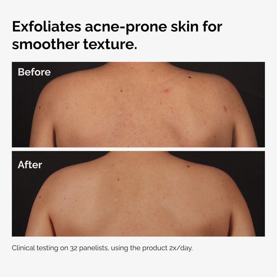 the-body-care-collection-n2 ord-salicylic-acid-body-serum-before-after-graphic-NA.jpg