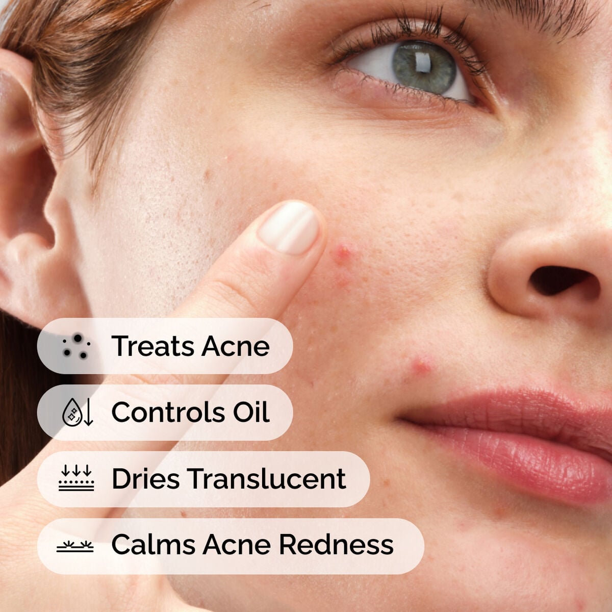 sulfur-10-powder-to-cream-concentrate-q9 ord-sulfur-10pct-powder-to-cream-concentrate-model-application-with-benefits-acne.jpg
