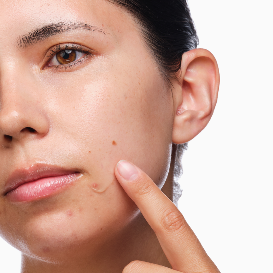 the-acne-set-p7 rdn-the-acne-set-application.png